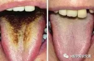 成人舌苔辨别图解视频,成人舌苔辨识技巧解析
