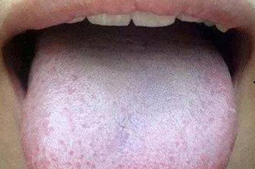 成人舌苔辨别图解视频,成人舌苔辨识技巧解析